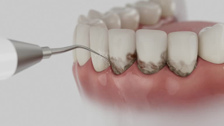 Trusted Wisdom Tooth Removal service in North Bethesda, MD - Dentist Open Now